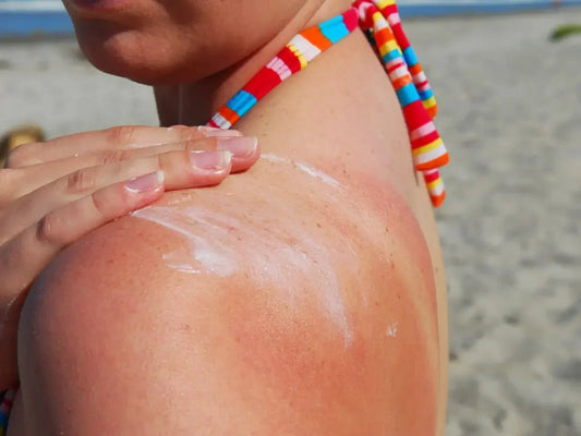 10 Natural Remedies for Sunburn: Effective Sunburn Natural Treatments