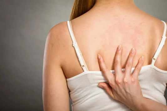Sulfite Allergy Symptoms and Treatments