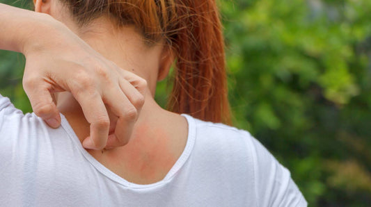 Natural Bug Bite Relief: 10+ Remedies for Itching, Swelling & Irritation